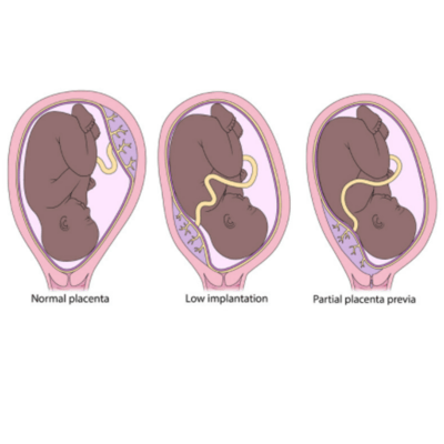 full-color illustrations of various placenta placements