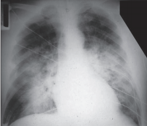 PA chest showing ARDS