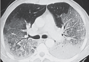 CT chest showing ARDS