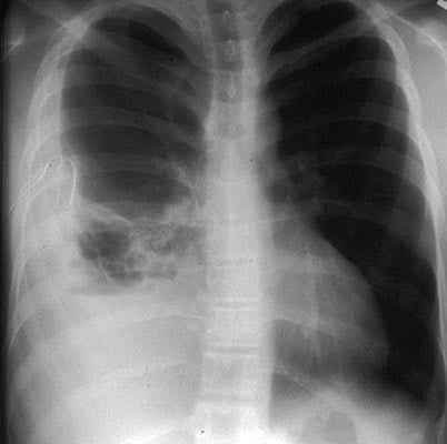 PA chest–right-side pleural effusion  Source: Vinay Maheshwari, MD