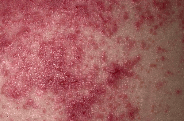 Dermatitis herpetiformis (DH). DH is a chronic vesicular eruption that is extremely pruritic and symmetric in distribution.