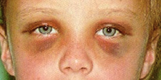 Racoon eyes and battle sign images—Source: Thomas Krzmarzick, MD