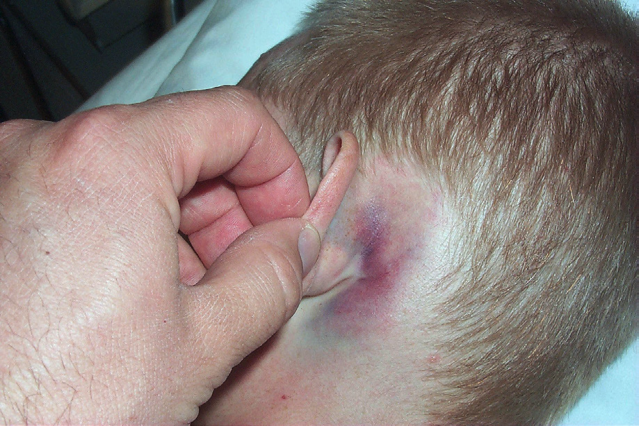 Prepare for Pediatric Head Injuries in the ED Around Halloween