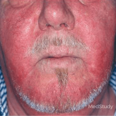 skin signs showing rosacea 