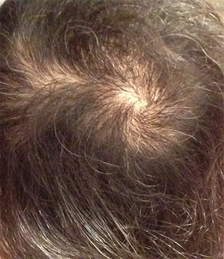 Alopecia areata